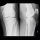 Calcification in patellar ligament, infrapatellar bursa: X-ray - Plain radiograph